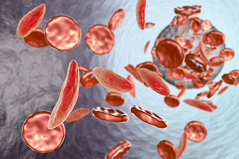image showing sickle cell disease